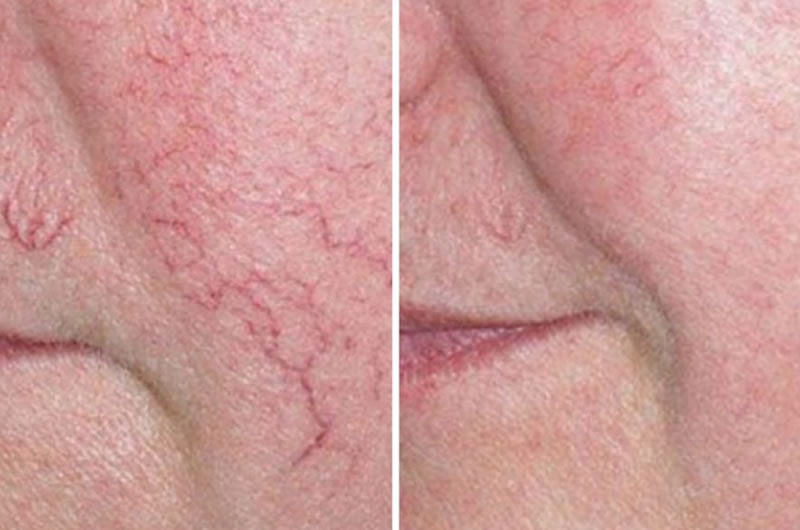 Before and After Spider Thread Vein Removal