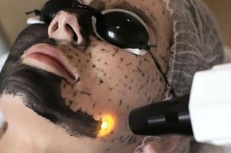Laser Carbon Facial Treatment