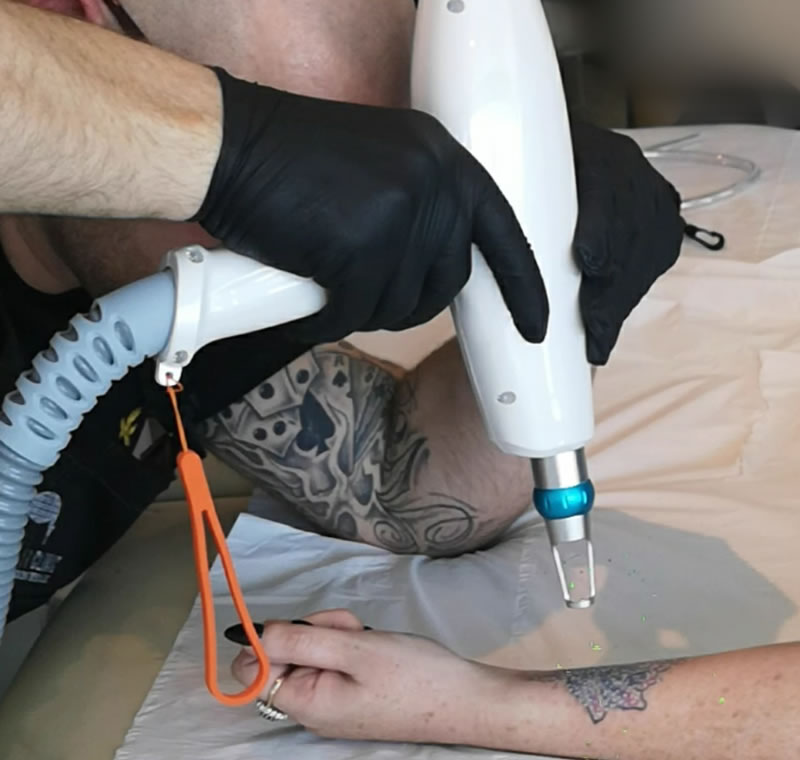 Laser Tattoo Removal on Arm